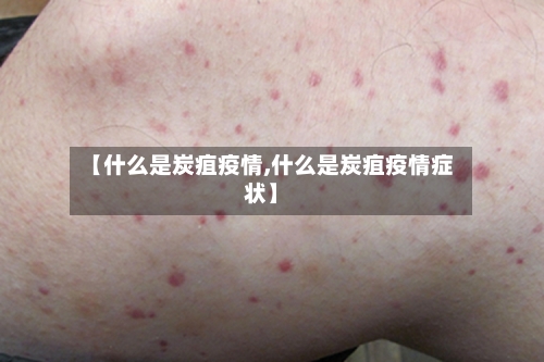 【什么是炭疽疫情,什么是炭疽疫情症状】-第1张图片